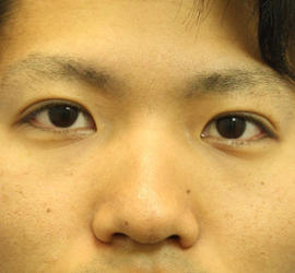 20代男性の二重埋没法 After 症例写真