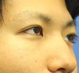 20代男性の二重埋没法 After 症例写真