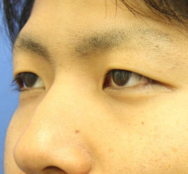 20代男性の二重埋没法 Before 症例写真