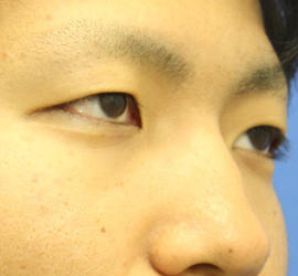 20代男性の二重埋没法 Before 症例写真