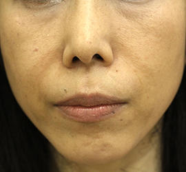 50代女性の真皮線維芽細胞療法 After 症例写真