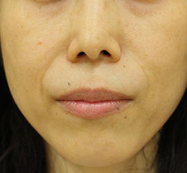 50代女性の真皮線維芽細胞療法 Before 症例写真