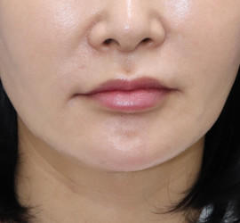 50代女性の真皮線維芽細胞療法 After 症例写真