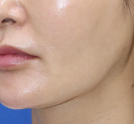 50代女性の真皮線維芽細胞療法 After 症例写真