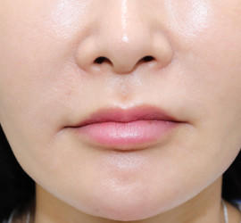 50代女性の真皮線維芽細胞療法 After 症例写真