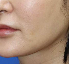 50代女性の真皮線維芽細胞療法 Before 症例写真