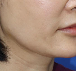 50代女性の真皮線維芽細胞療法 Before 症例写真