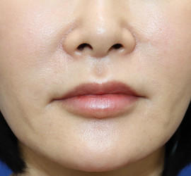 50代女性の真皮線維芽細胞療法 Before 症例写真