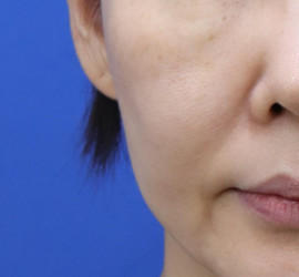 50代女性の真皮線維芽細胞療法 After 症例写真