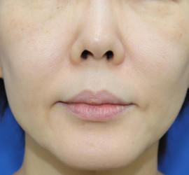 50代女性の真皮線維芽細胞療法 After 症例写真