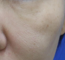 50代女性の真皮線維芽細胞療法 After 症例写真