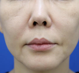 50代女性の真皮線維芽細胞療法 Before 症例写真