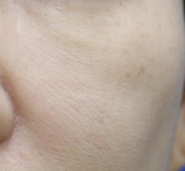 50代女性の真皮線維芽細胞療法 Before 症例写真