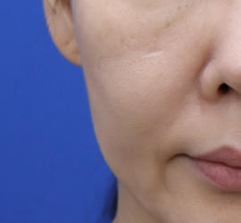 50代女性の真皮線維芽細胞療法 Before 症例写真