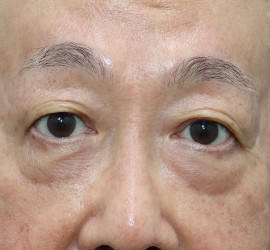 60代男性の真皮線維芽細胞療法 After 症例写真