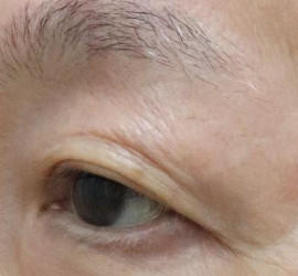 60代男性の真皮線維芽細胞療法 After 症例写真