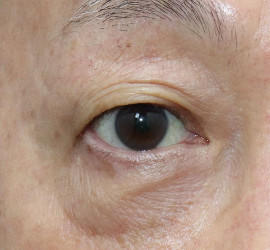 60代男性の真皮線維芽細胞療法 After 症例写真