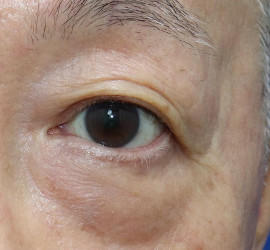 60代男性の真皮線維芽細胞療法 After 症例写真