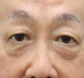 60代男性の真皮線維芽細胞療法 Before 症例写真