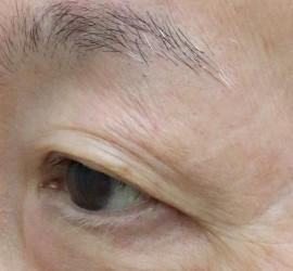 60代男性の真皮線維芽細胞療法 Before 症例写真