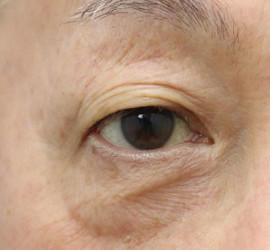 60代男性の真皮線維芽細胞療法 Before 症例写真