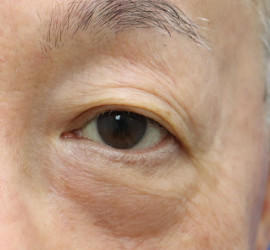 60代男性の真皮線維芽細胞療法 Before 症例写真