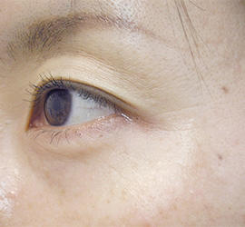 40代女性のシミ・そばかす After 症例写真