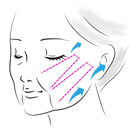 3Dリフトロングの糸挿入イメージ