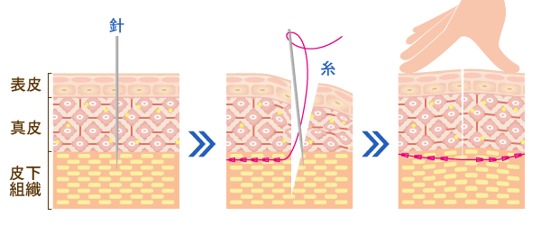 3Dリフトロングの糸挿入の解説