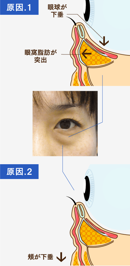 目の下のクマ・たるみの原因のイメージ