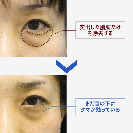 目の下のクマ・たるみの改善のイメージ