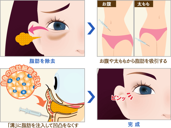 3Dリポアイリフトのイメージ