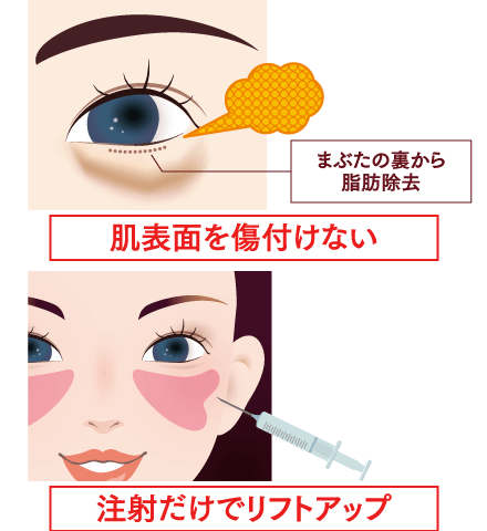 3Dリポアイリフトのイメージ