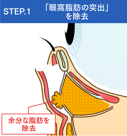 「眼窩脂肪の突出」を除去するイメージ