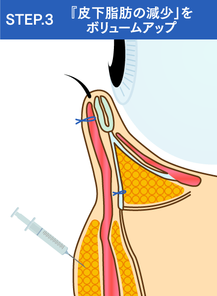 「皮下脂肪の減少」をボリュームアップするイメージ