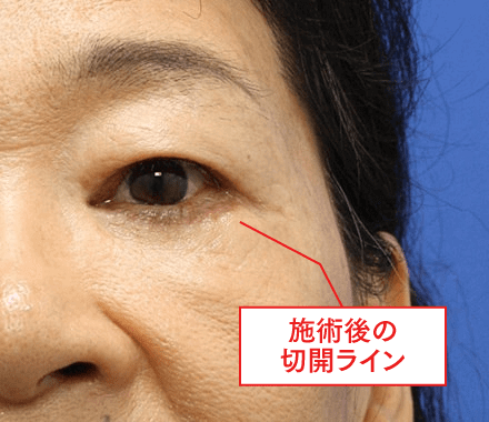 3Dパーフェクトアイリフトの自然な仕上がりイメージ