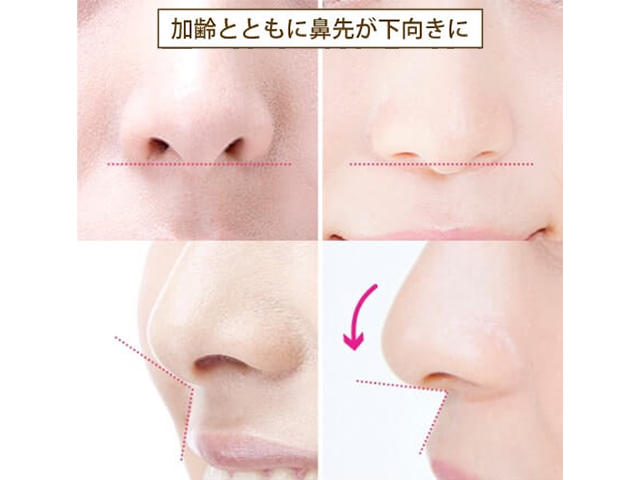 ボトックス アップノーズ 公式 オザキクリニック ボトックス アップノーズ 公式 オザキクリニック