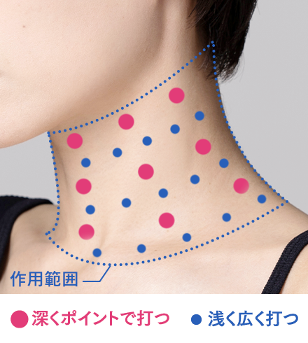 ネックリフトの注入ポイント