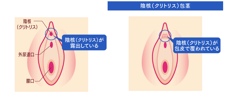 クリトリス露出 