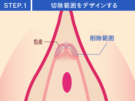 STEP1:切除範囲をデザインする