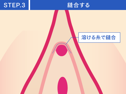 STEP3:縫合する