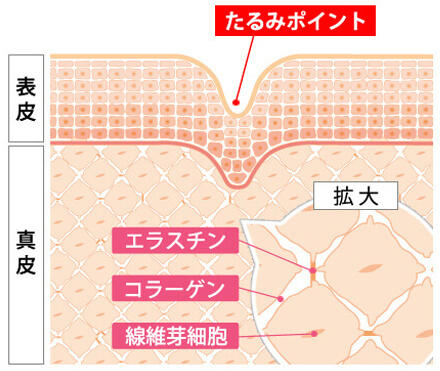 コラーゲン不足による肌のたるみのイメージ