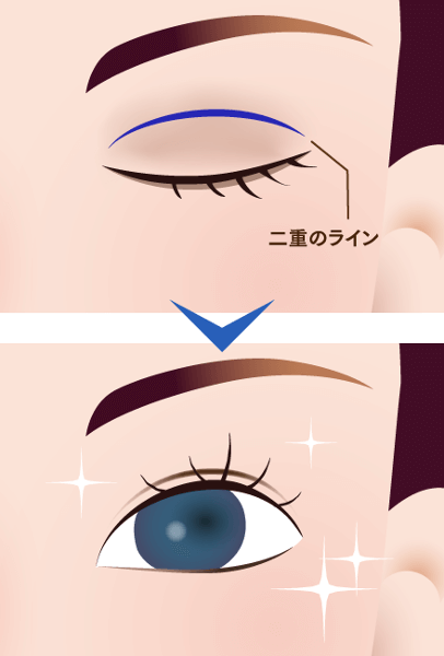 繰り返さない二重まぶた整形のイメージ
