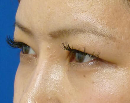 全切開二重まぶた法のイメージ