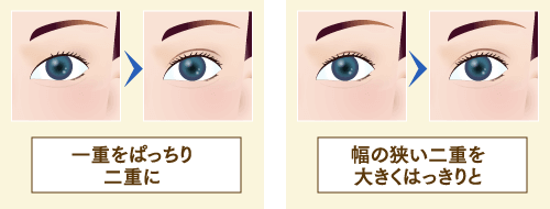 全切開二重まぶた法のイメージ
