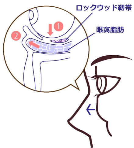 加齢とともに現われる目の下の膨らみのイメージ
