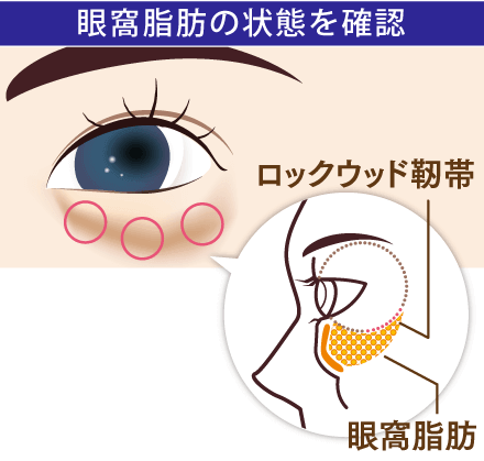 眼窩脂肪の状態を確認するイメージ