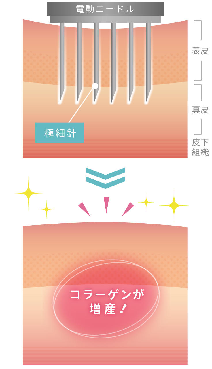 ダーマペン4の作用の様子