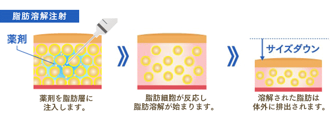 『脂肪溶解注射』(痩身ダイエット)で痩せるメカニズムのイメージ