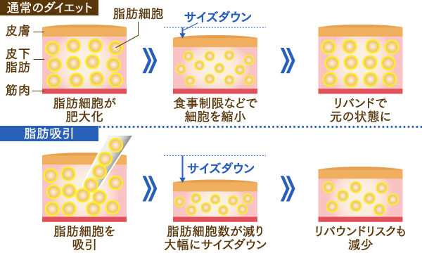脂肪吸引のイメージ